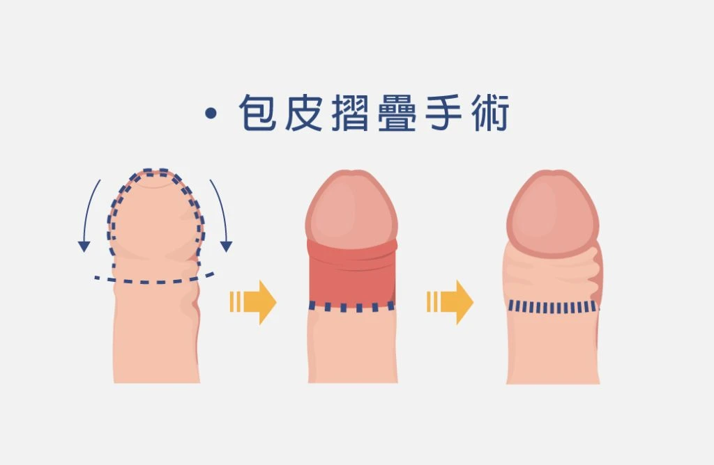 陰莖增大手術全解析：增粗、增長、龜頭增大方式與費用說明