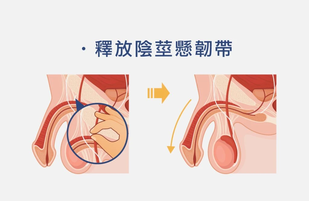 釋放陰莖懸韌帶示意圖
