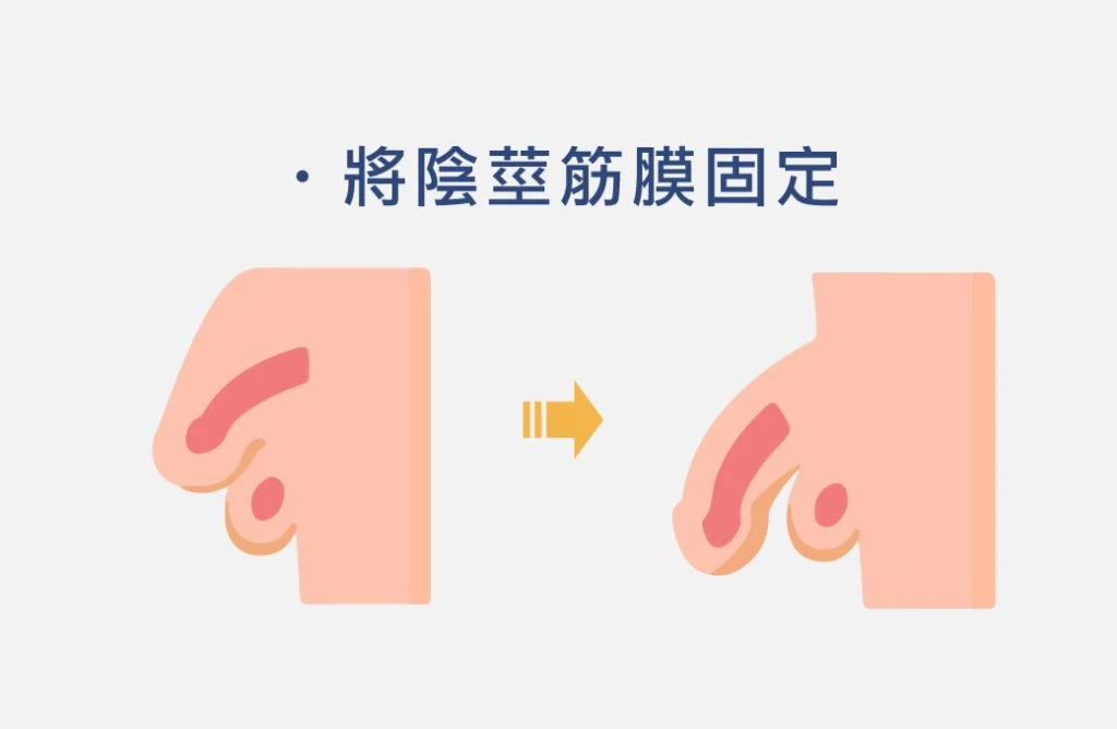 陰莖筋膜固定示意圖