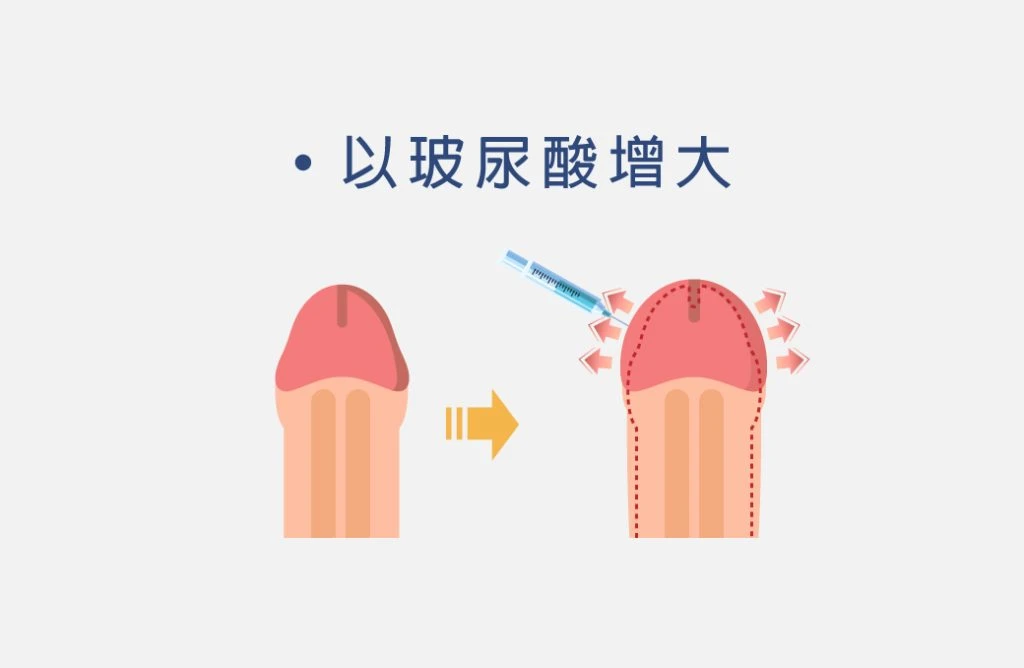 龜頭玻尿酸注射示意圖