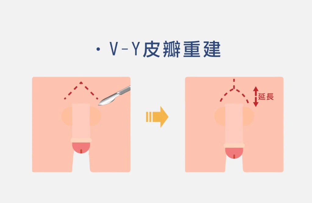 V-Y皮瓣重建示意圖
