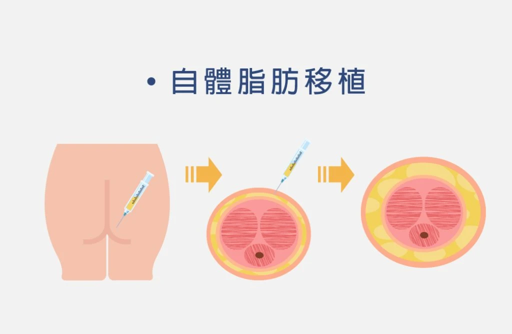 自體脂肪移植示意圖